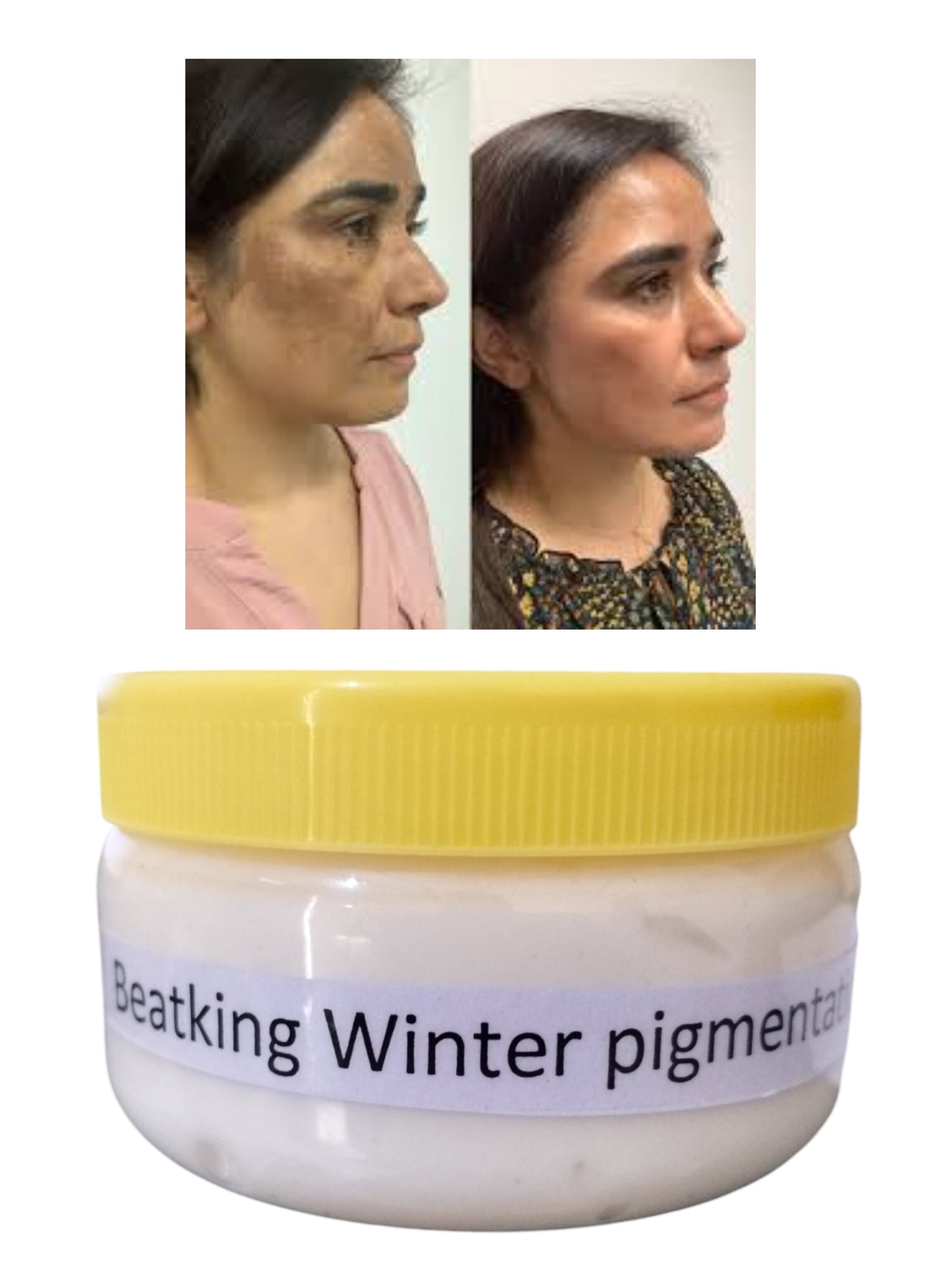 Beatking Winter pigmentation cream 150g| best results |unisex