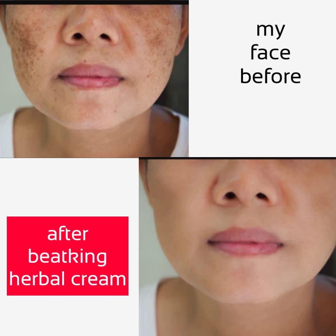 beatking day&night cream for pigmentation |Removing Dark Spots | Acne Scars | blackheads, Even Skin, Blemishes | soft skin, it really work ,men & women (60+60 gm) pack of 2pcs