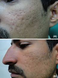 9 type skin problem solution kit for pigmentation,darkspot ,melasma, openpores