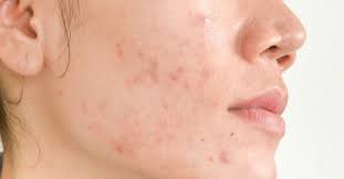 Winter combo for pigmentation,dark spot,melasma