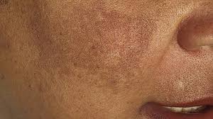 Winter combo for pigmentation,dark spot,melasma