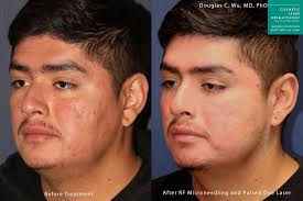 Winter combo for pigmentation,dark spot,melasma