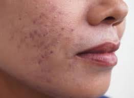 Winter combo for pigmentation,dark spot,melasma