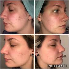 9 type skin problem solution kit for pigmentation,darkspot ,melasma, openpores