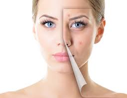 Beatking Acne And Scar Treatment Kit