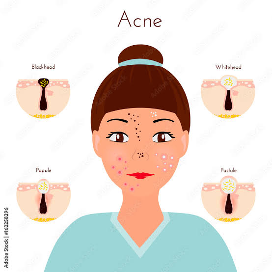 Beatking Acne And Scar Treatment Kit