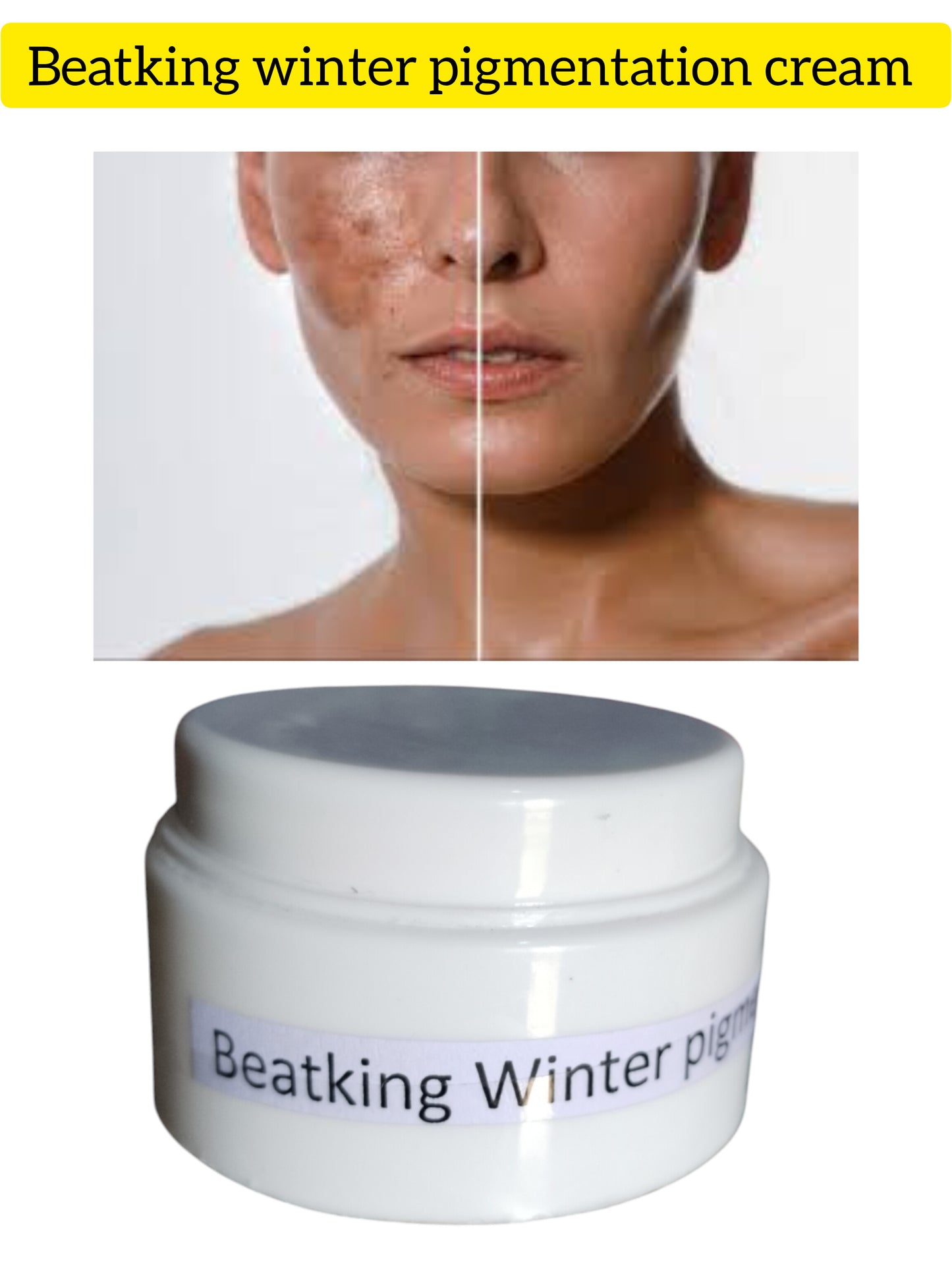 Beatking winter pigmentation cream 50g| man and woman| pure herbal no side effects