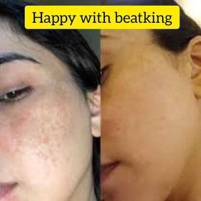 Beatking Vvip combo for Pigmentation,melasma,openpores,darkspot,sunburn,acne| pack of 5