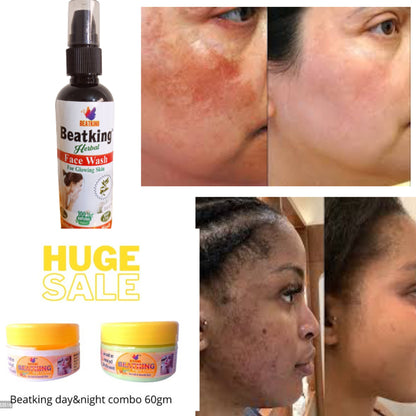 Beatking Vvip combo for Pigmentation,melasma,openpores,darkspot,sunburn,acne| pack of 5