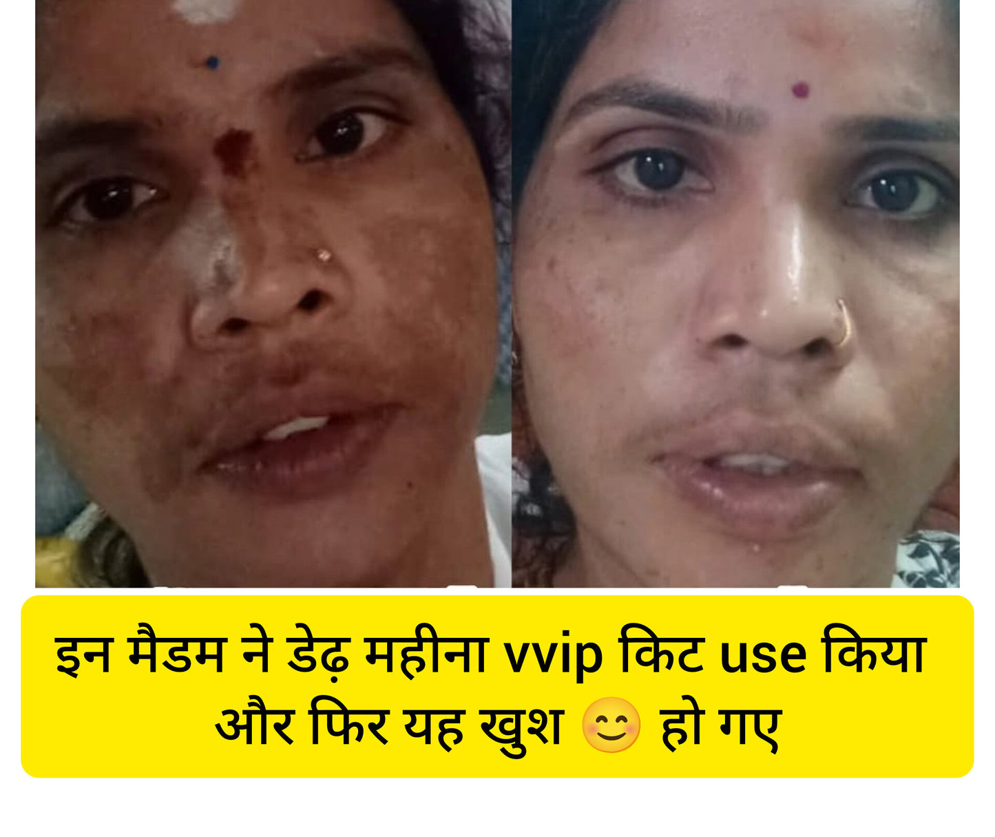 Beatking day cream, removes scar and pigment, for glowing skin
