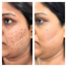 9 type skin problem solution kit for pigmentation,darkspot ,melasma, openpores