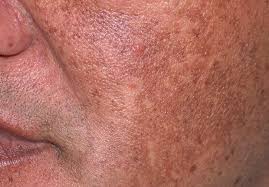 Winter combo for pigmentation,dark spot,melasma