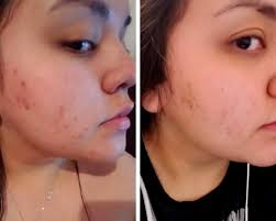 beatking day&night cream for pigmentation |Removing Dark Spots | Acne Scars | blackheads, Even Skin, Blemishes | soft skin, it really work ,men & women (60+60 gm) pack of 2pcs