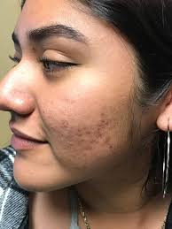Winter combo for pigmentation,dark spot,melasma