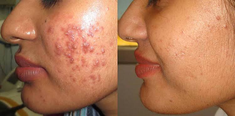 Acne and scar treatment